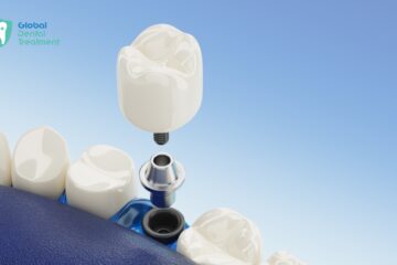 Cheapest Countries for All on 4 Dental Implants Cheapest Countries for All-on-4 Dental Implants