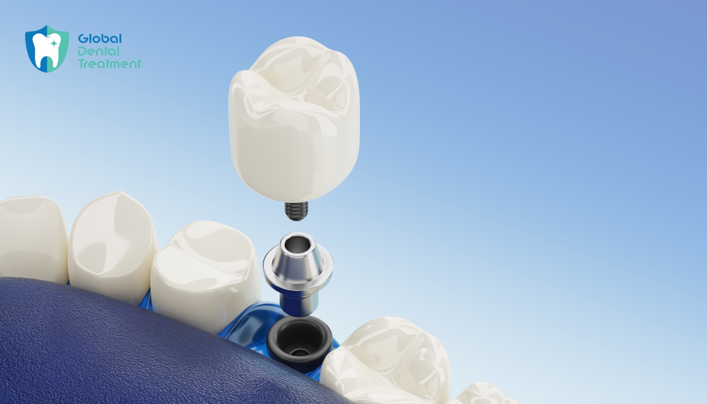 Cheapest Countries for All-on-4 Dental Implants